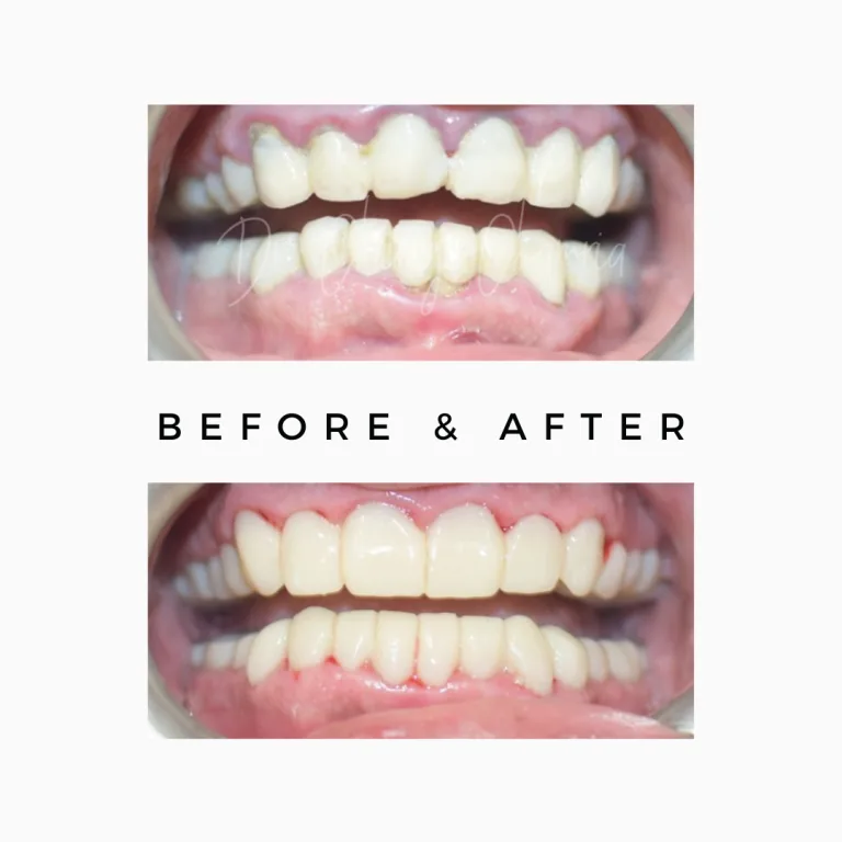Single Sitting Root Canal & Tooth Restoration Case Study 2 in Jaipur - Royal Dental Clinic