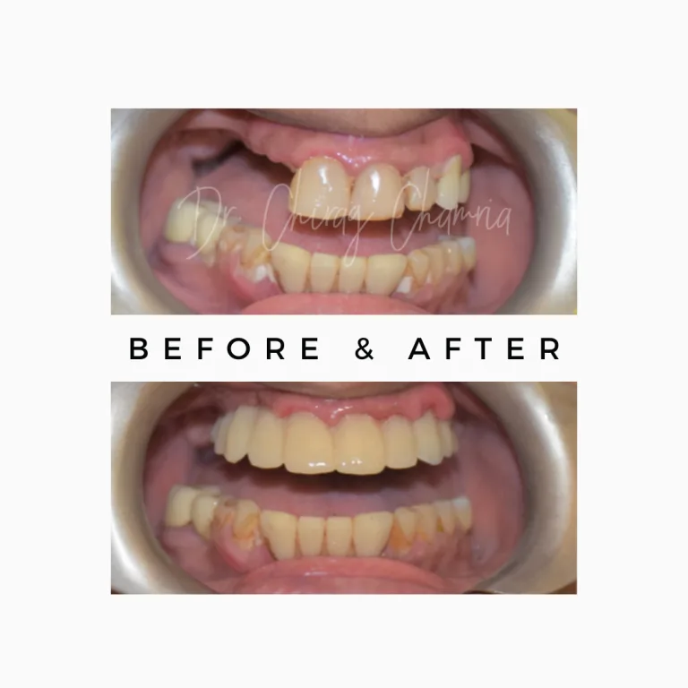 Single Sitting Root Canal & Tooth Restoration Case Study 3 in Jaipur - Royal Dental Clinic